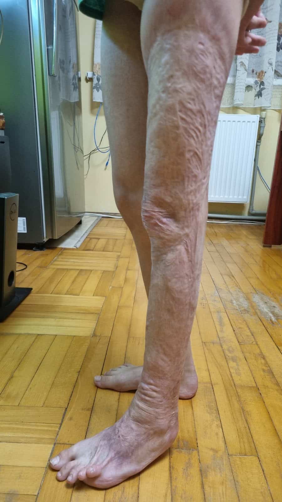 Close-up of Veronika’s leg showing burn scars from injuries sustained as a child.